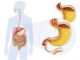 wizualizacja refluksu żołądkowego u człowieka